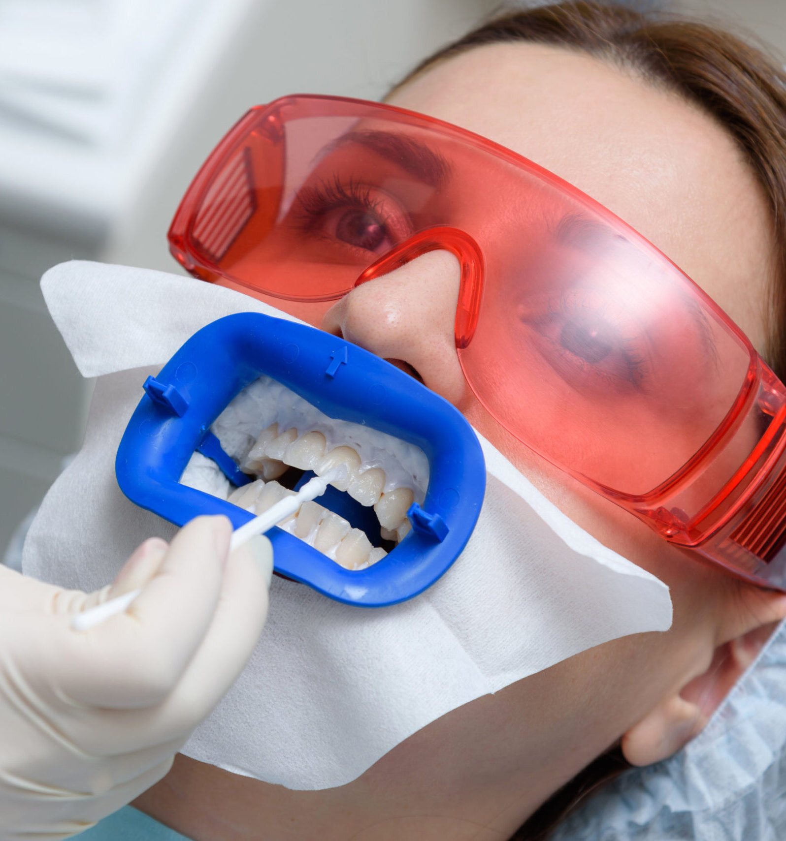 there is a preparation of the oral cavity to bleaching with the help of an ultraviolet lamp. Close-up