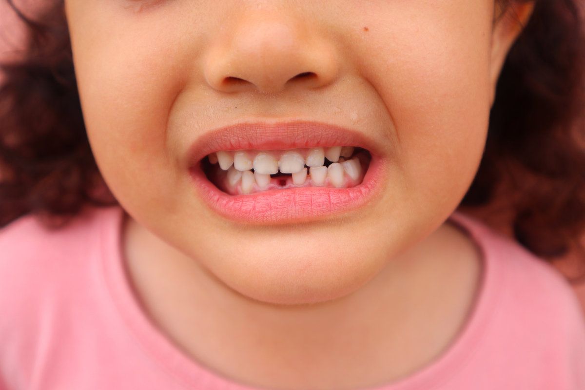 An Asian female toddler shows her newly knocked out teeth and looks toothless, close up.