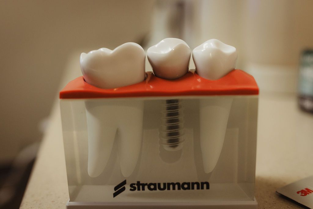 Straumann dental implant model showing three crown restoration stages on red gum base